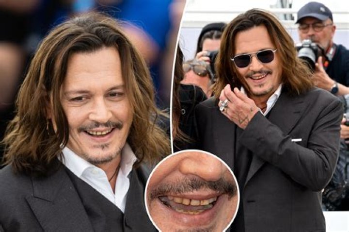 Johnny Depp’s teeth “rotting” due to wear & tear, says celebrity dentist Dr. Apa.